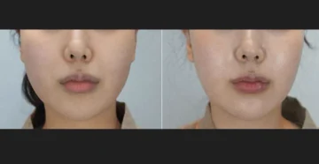 인모드 정면 전후사진