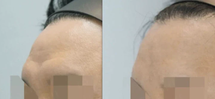 이마·미간 주름 필러 측면 전후사진