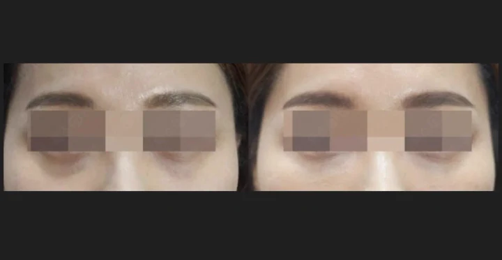 눈밑 꺼짐 필러 정면 전후사진