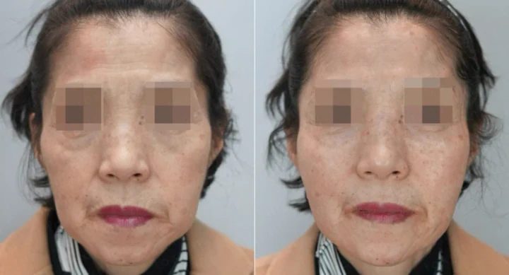 풀페이스 필러 정면 전후사진