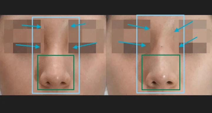 코 필러 정면 전후사진