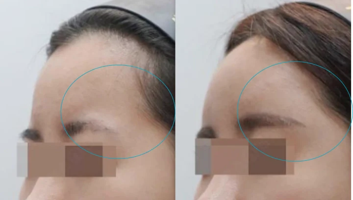 관자 필러 45도 전후사진