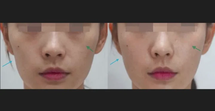 앞광대 필러 + 볼 필러 정면 전후사진