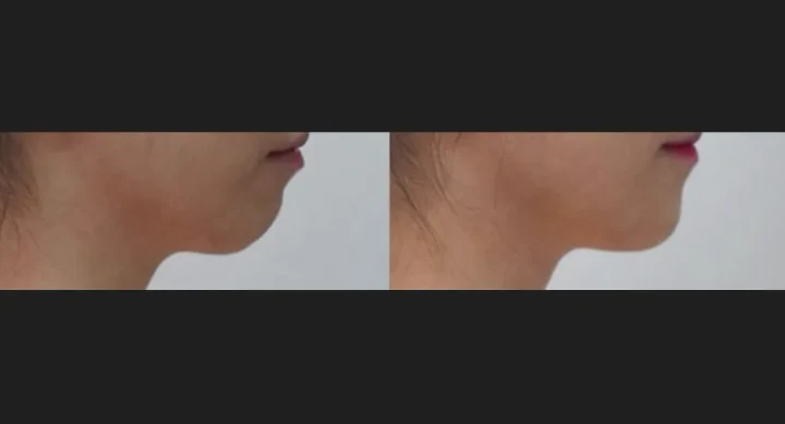 턱 필러 측면 전후사진