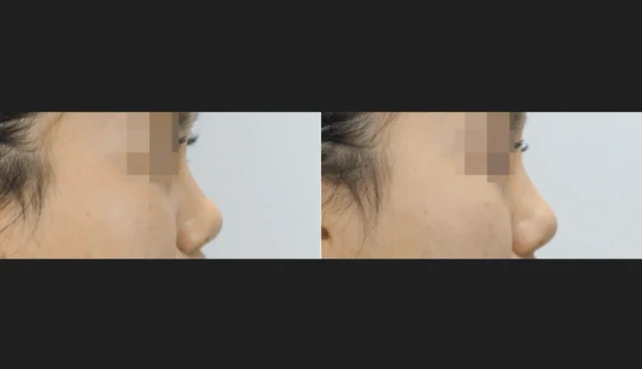 코필러 측면 전후사진
