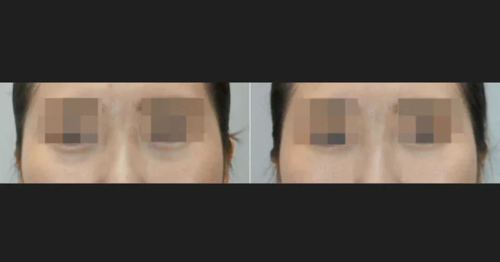 다크서클 필러 정면 전후사진