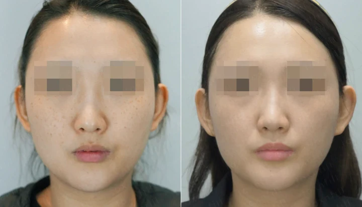 주근깨 얼굴 전체 전후사진