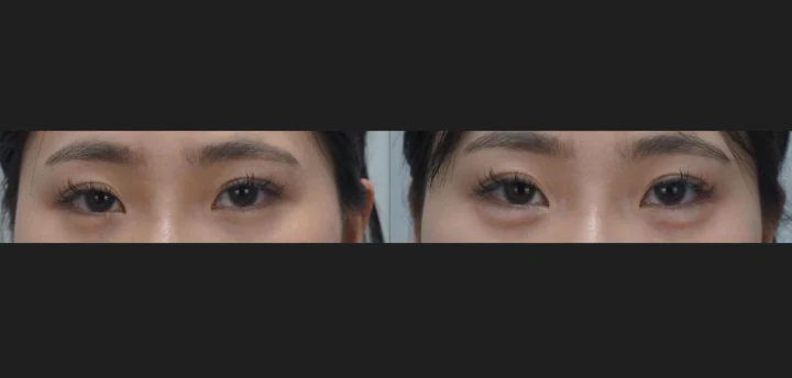 애교 필러 정면 전후사진