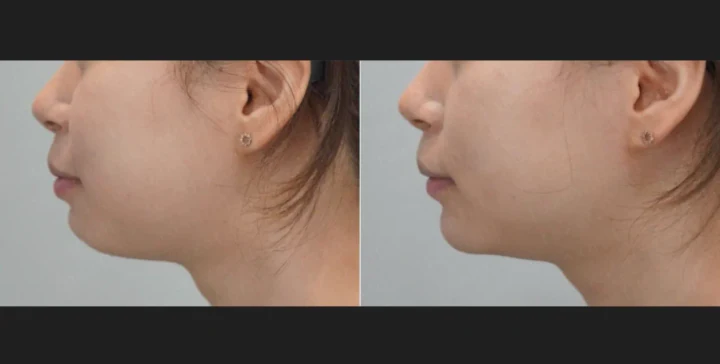 턱끝 필러 측면 전후사진