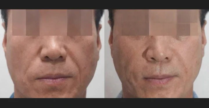 팔자 필러 정면 전후사진
