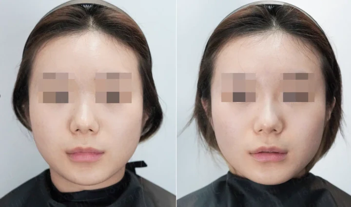 코 필러 정면 전후사진