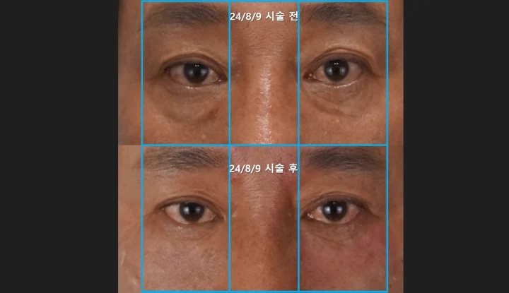 눈밑꺼짐 필러 정면 전후사진