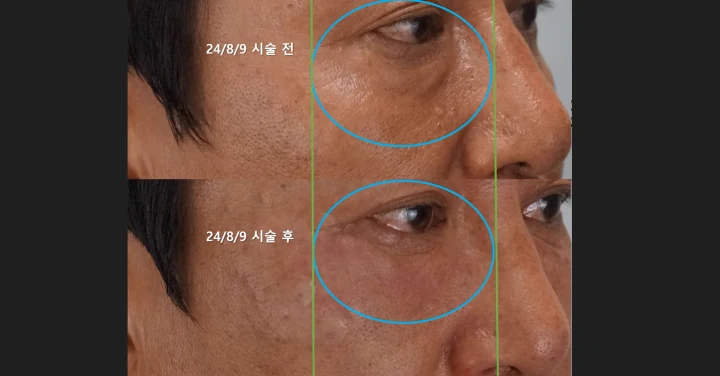 눈밑꺼짐 필러 45도 전후사진