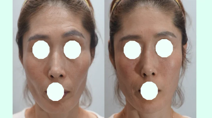 풀페이스 필러 정면 전후사진
