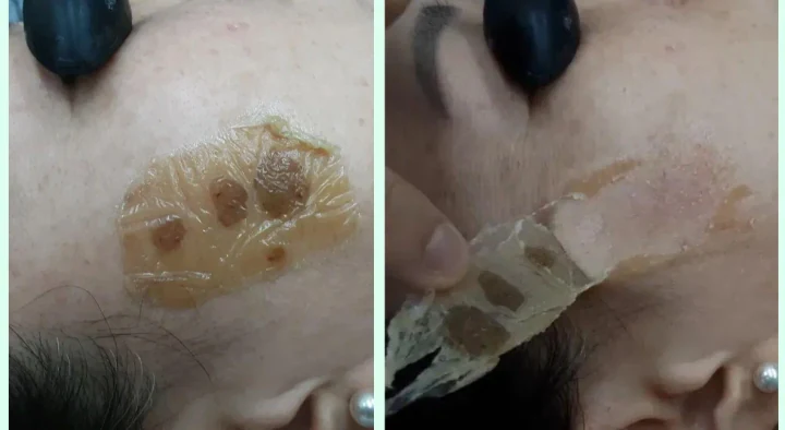 흑자(리팟) 측면 전후사진
