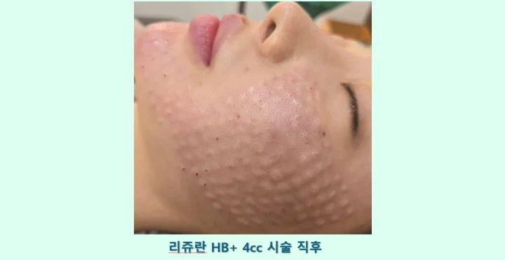리쥬란hb+ 4cc 시술 직후 측면 전후사진
