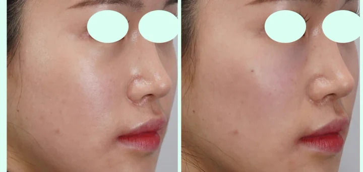 눈밑 + 앞광대 필러 측면 전후사진
