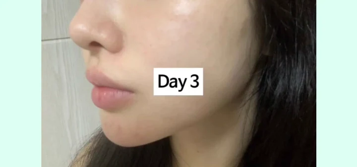 리쥬란HB+ 2일차~5일차 엠보 변화 3일차 전후사진
