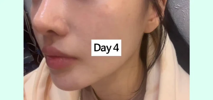 리쥬란HB+ 2일차~5일차 엠보 변화 4일차 전후사진