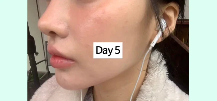 리쥬란HB+ 2일차~5일차 엠보 변화 5일차 전후사진