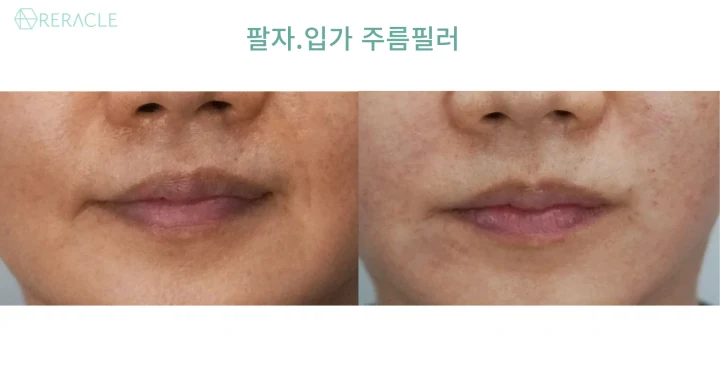 팔자주름+입가주름필러 정면 전후사진