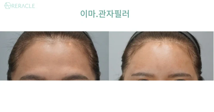 이마+관자필러 정면 전후사진