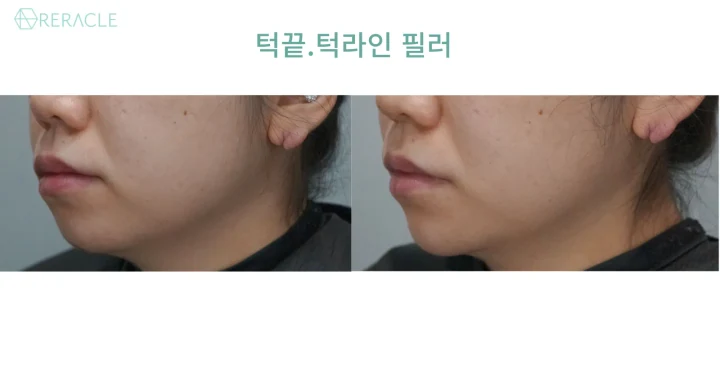 턱끝·턱라인 필러 45도 전후사진