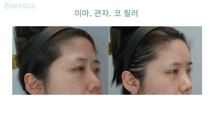 코필러 45도 전후사진
