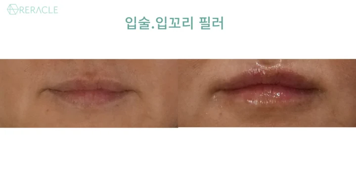 입술·입꼬리 필러 정면 전후사진