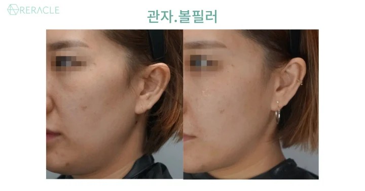 볼필러 45도 전후사진