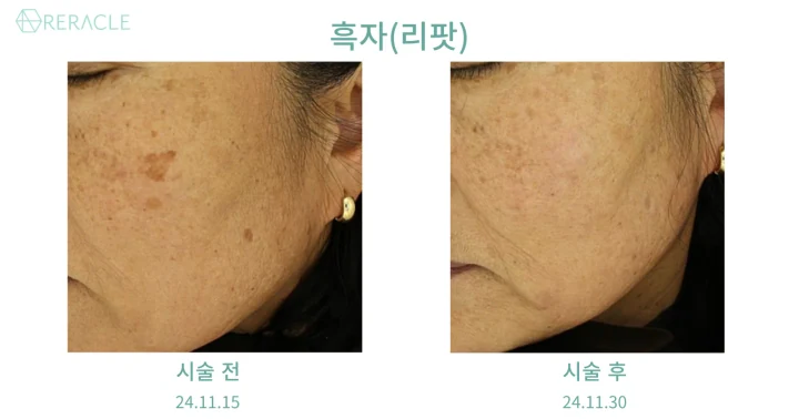 흑자(리팟) 45도 전후사진