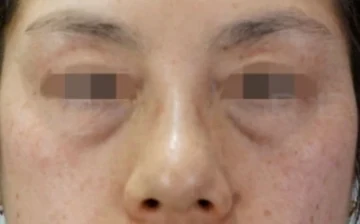 눈밑지방 돌출과 눈밑꺼짐이 보이는 눈밑필러 시술 전 정면 사진