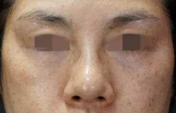앞광대와 눈밑필러 시술 4주 후 정면 사진
