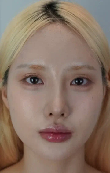 이마필러 시술 직후 정면 사진