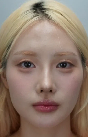이마필러 시술 전 정면 사진