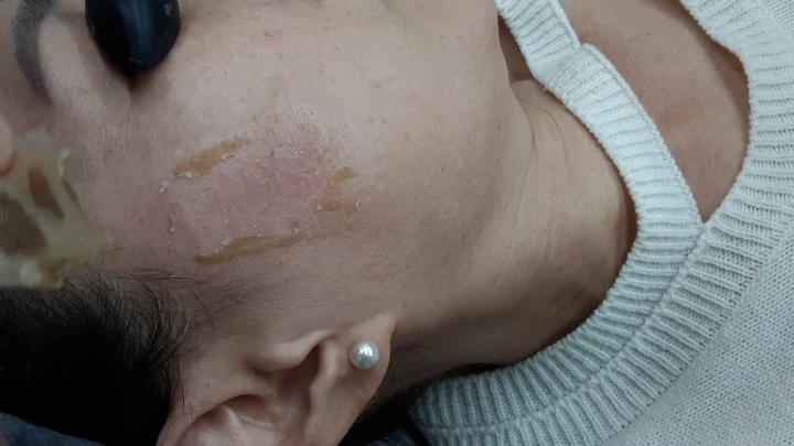 리팟 치료 2주 후 듀오덤 제거 직후 분홍빛 피부가 드러난 영상의 한 장면