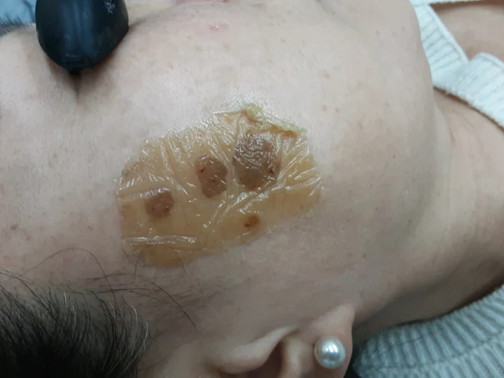 흑자 치료 부위에 듀오덤이 붙어 있는 상태의 제공 사진