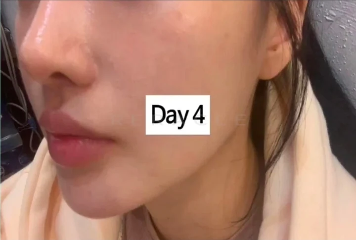 리쥬란 HB+ 4cc 시술 경과 Day 4 · 시술 3일 후