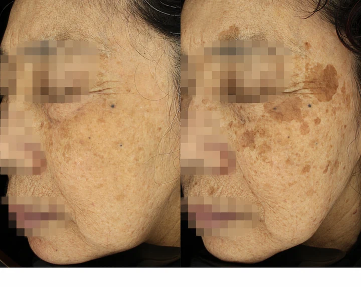 눈가 바깥쪽과 광대 부위의 갈색 반점을 비교한 모자이크 사진