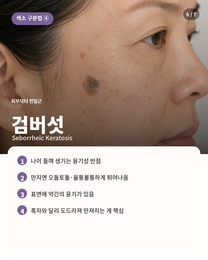 피부에서 도드라져 보이는 검버섯과 표면의 특징을 설명하는 리라클 교육용 카드