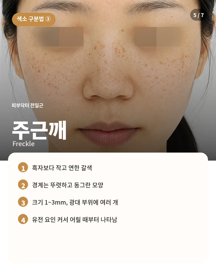 주근깨의 크기, 분포, 어린 시절부터 나타나는 특징을 설명하는 리라클 교육용 카드