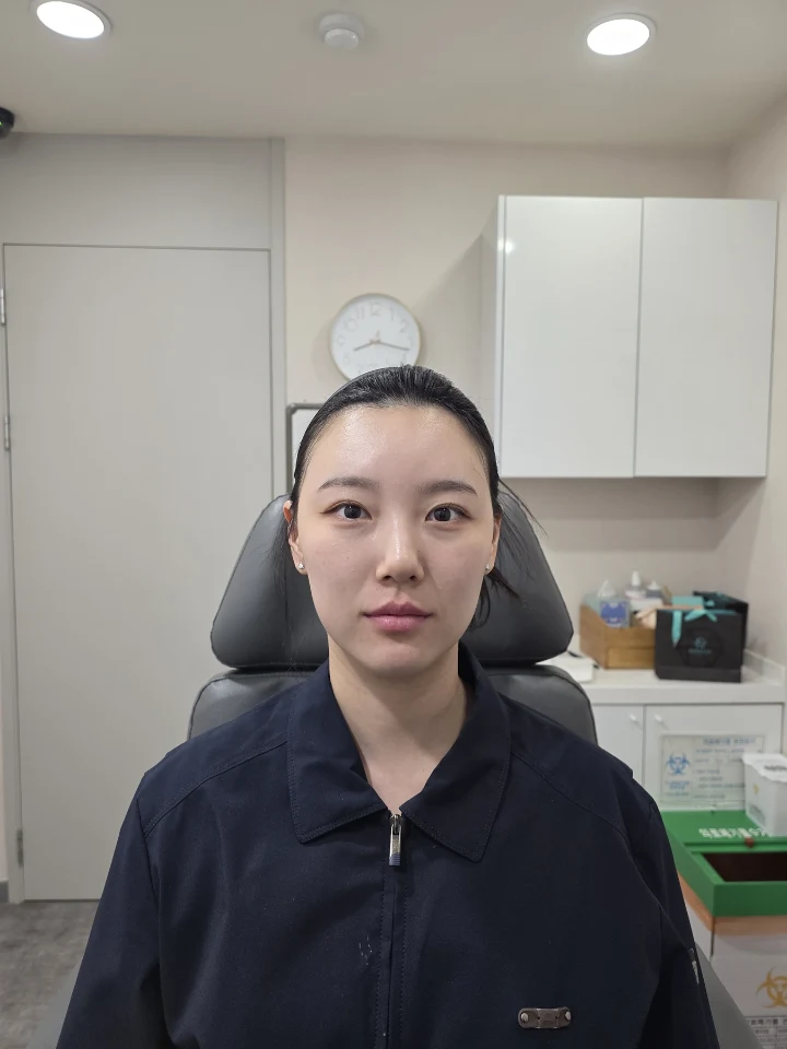 입술필러 전후사진