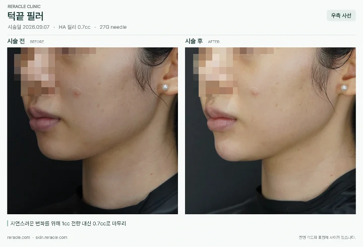 턱끝필러 전후사진
