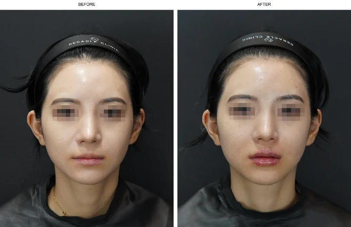 입술필러 전후사진
