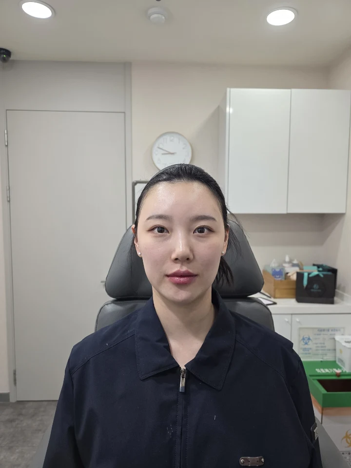 입술필러 전후사진