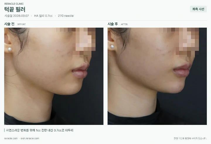 턱끝필러 전후사진