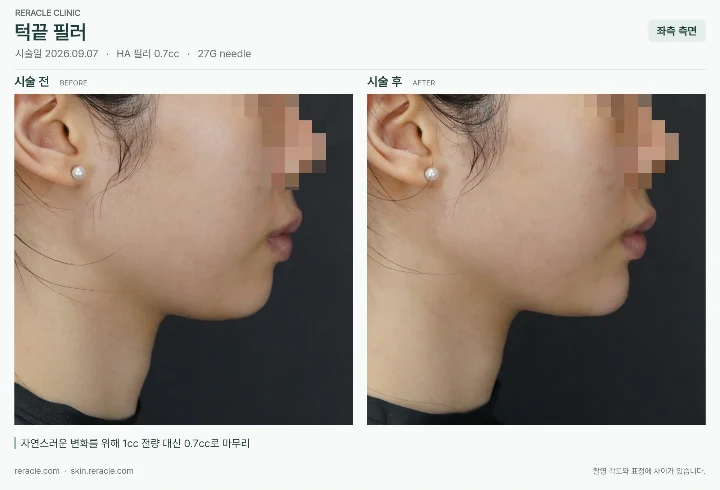 턱끝필러 전후사진