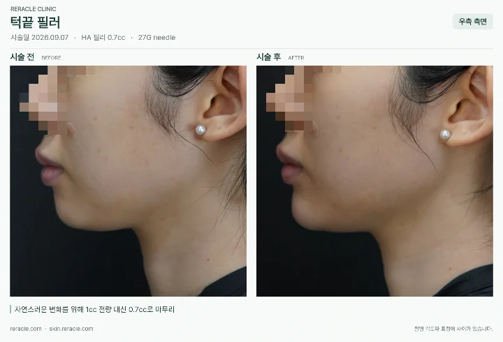 턱끝필러 전후사진