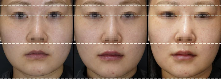 입술필러 전후사진
