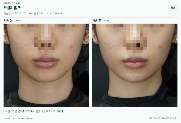 턱끝필러 전후사진